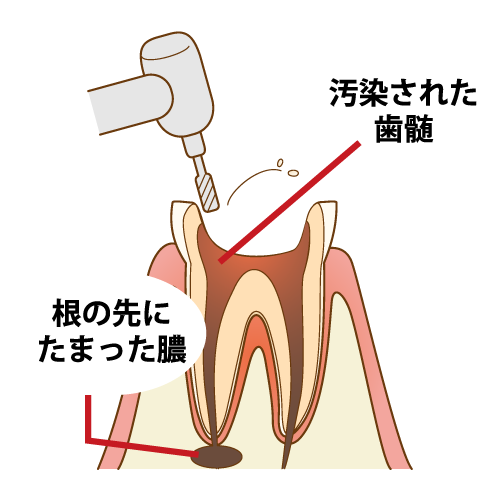 保存治療