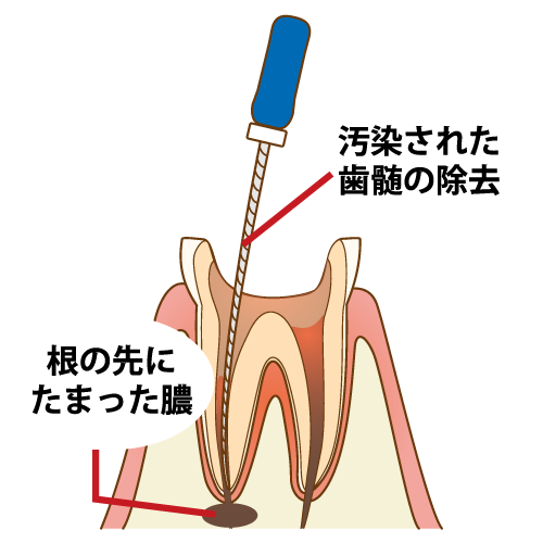 保存治療